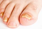 Toenail Fungus Fixers From Your Kitchen Cupboard